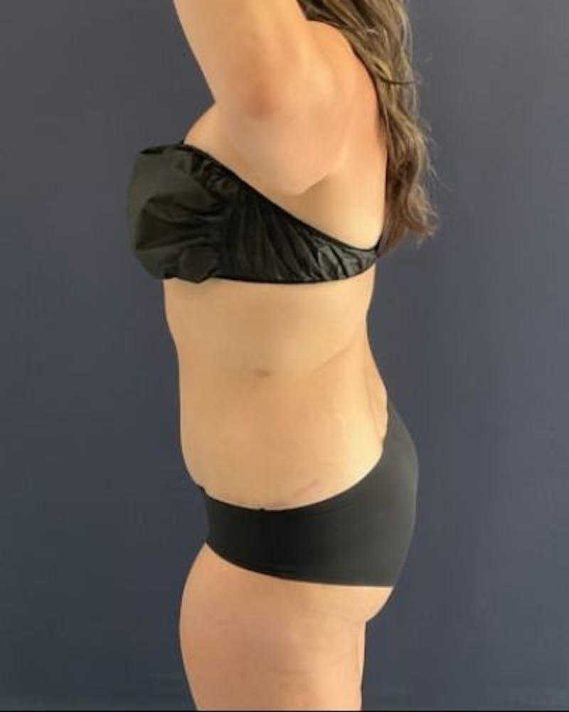 Tummy Tuck Before & After Gallery - Patient 391483 - Image 8