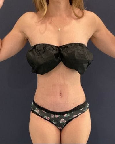 Tummy Tuck Before & After Gallery - Patient 213001 - Image 2