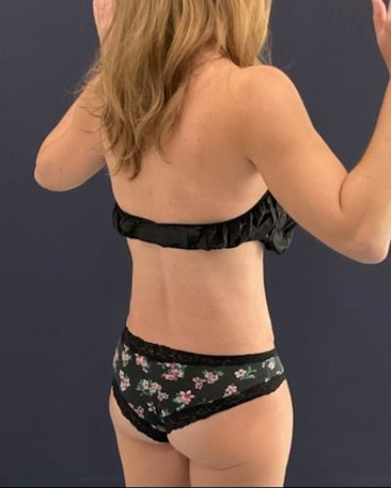 Tummy Tuck Before & After Gallery - Patient 213001 - Image 8