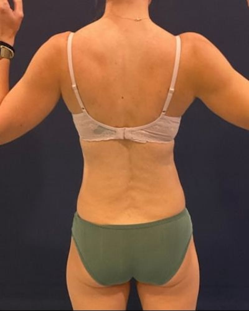 Tummy Tuck Before & After Gallery - Patient 213001 - Image 9