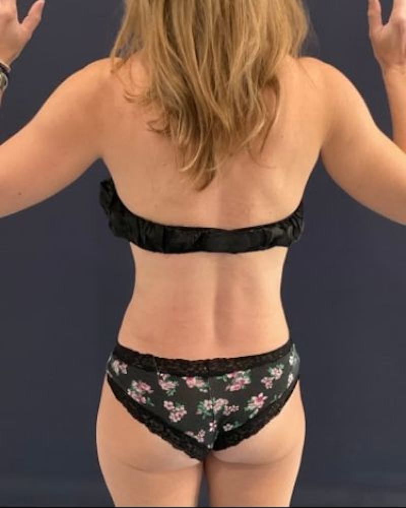 Tummy Tuck Before & After Gallery - Patient 213001 - Image 10
