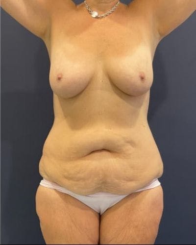 Tummy Tuck Before & After Gallery - Patient 145889 - Image 1
