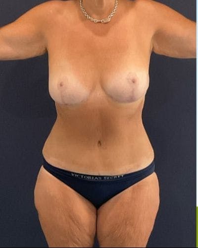 Tummy Tuck Before & After Gallery - Patient 145889 - Image 2