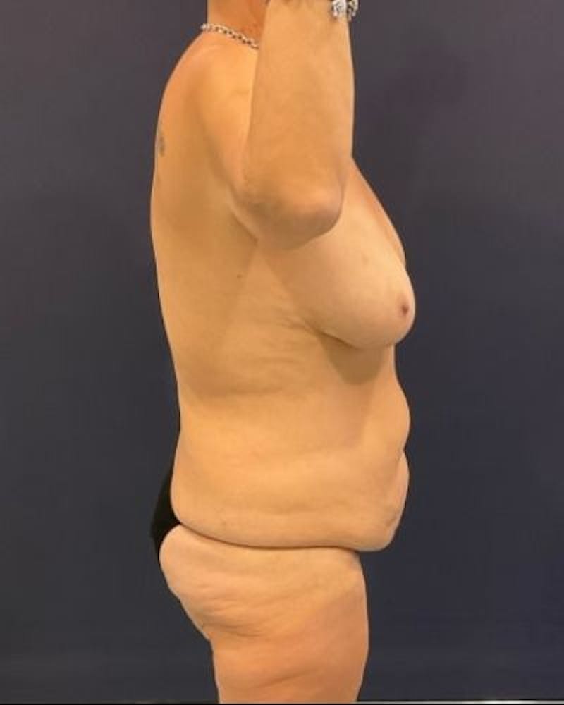 Tummy Tuck Before & After Gallery - Patient 145889 - Image 5