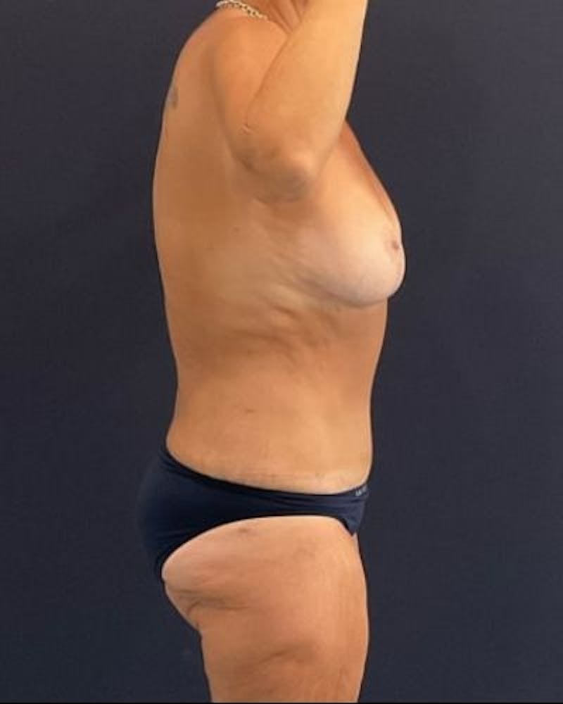 Tummy Tuck Before & After Gallery - Patient 145889 - Image 6