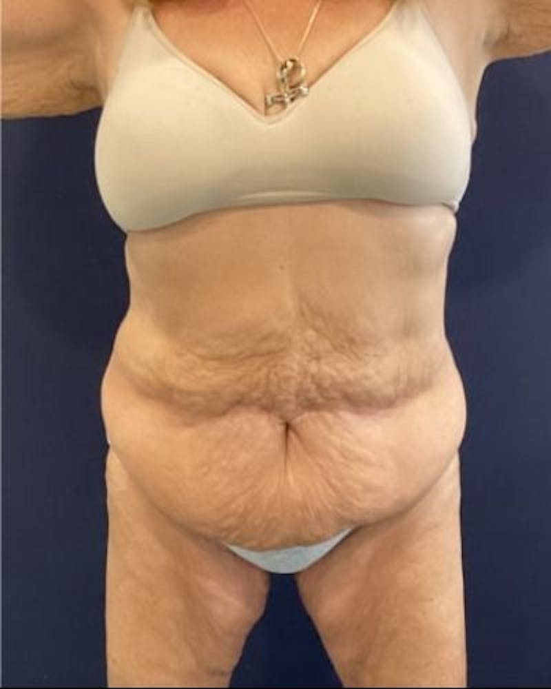 Tummy Tuck Before & After Gallery - Patient 352042 - Image 1