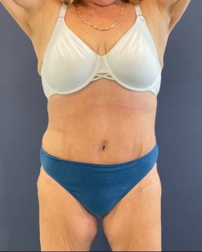 Tummy Tuck Before & After Gallery - Patient 352042 - Image 2
