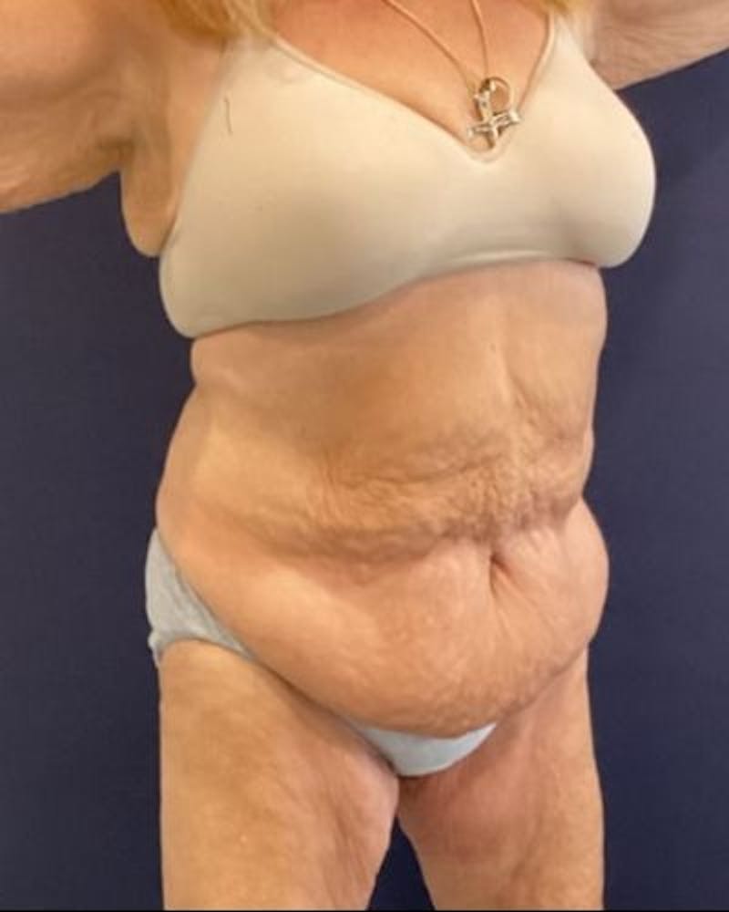 Tummy Tuck Before & After Gallery - Patient 352042 - Image 3