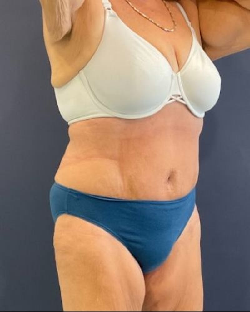 Tummy Tuck Before & After Gallery - Patient 352042 - Image 4