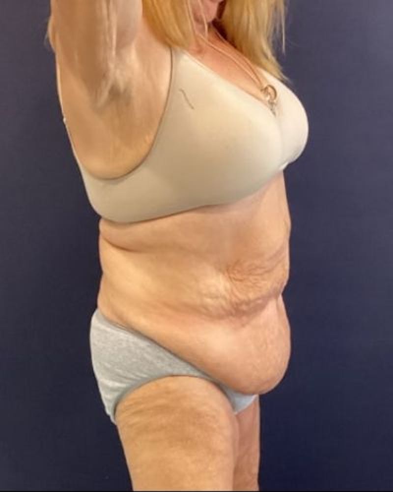 Tummy Tuck Before & After Gallery - Patient 352042 - Image 5
