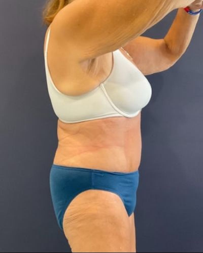Tummy Tuck Before & After Gallery - Patient 352042 - Image 6