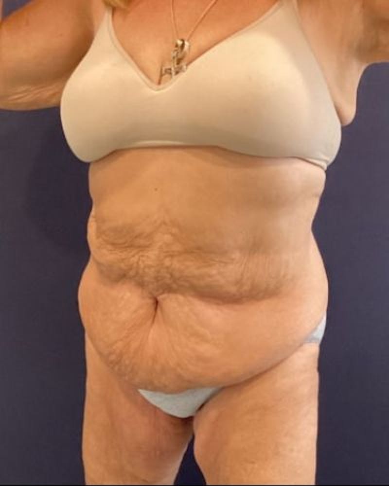 Tummy Tuck Before & After Gallery - Patient 352042 - Image 7