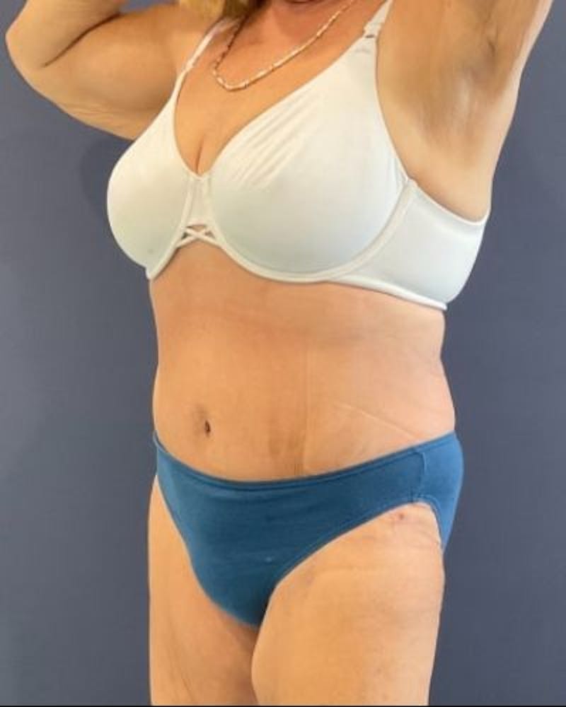 Tummy Tuck Before & After Gallery - Patient 352042 - Image 8