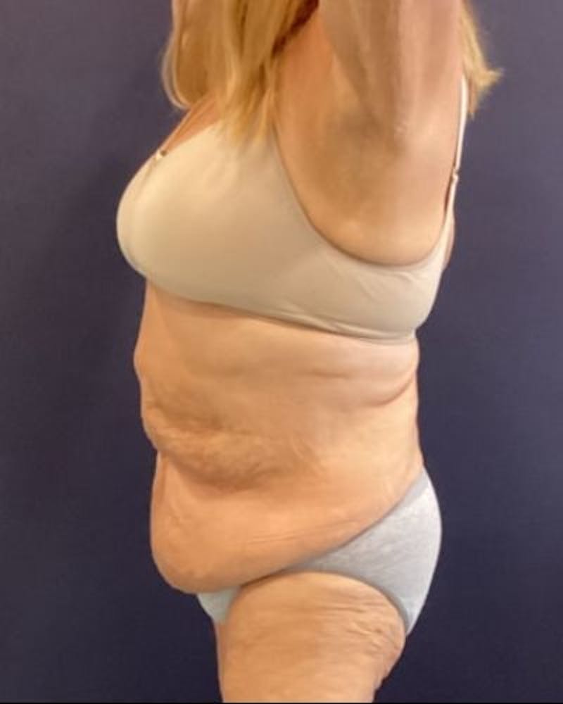 Tummy Tuck Before & After Gallery - Patient 352042 - Image 9