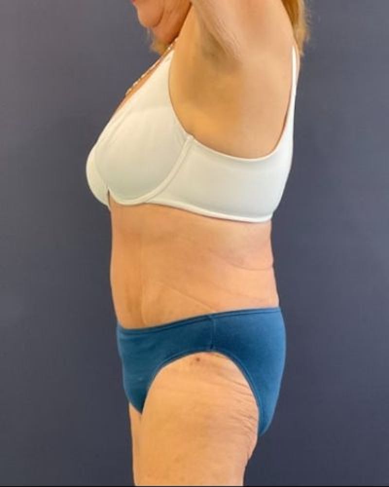 Tummy Tuck Before & After Gallery - Patient 352042 - Image 10
