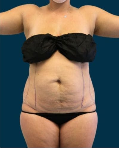 Tummy Tuck Before & After Gallery - Patient 310180 - Image 1