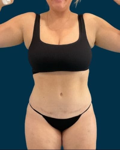 Tummy Tuck Before & After Gallery - Patient 310180 - Image 2