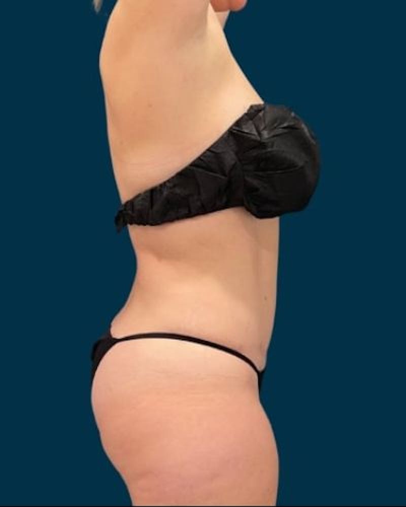 Tummy Tuck Before & After Gallery - Patient 310180 - Image 4
