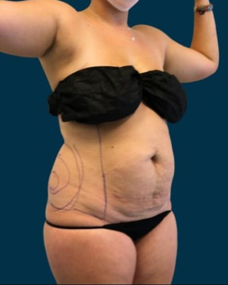 Tummy Tuck Before & After Gallery - Patient 310180 - Image 5