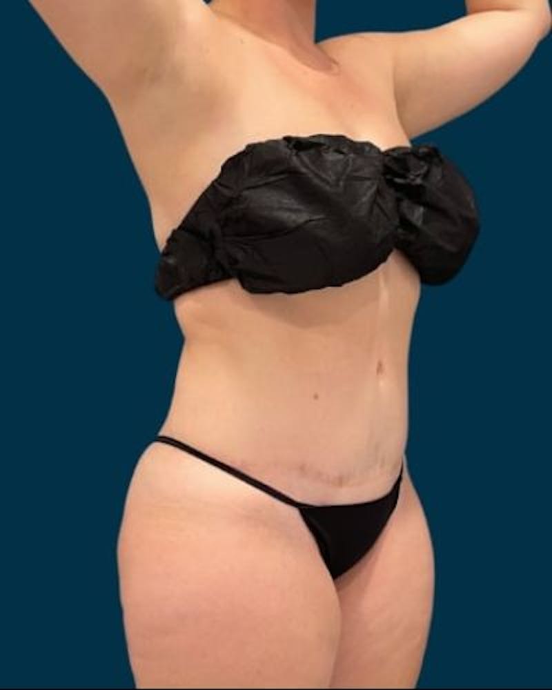 Tummy Tuck Before & After Gallery - Patient 310180 - Image 6