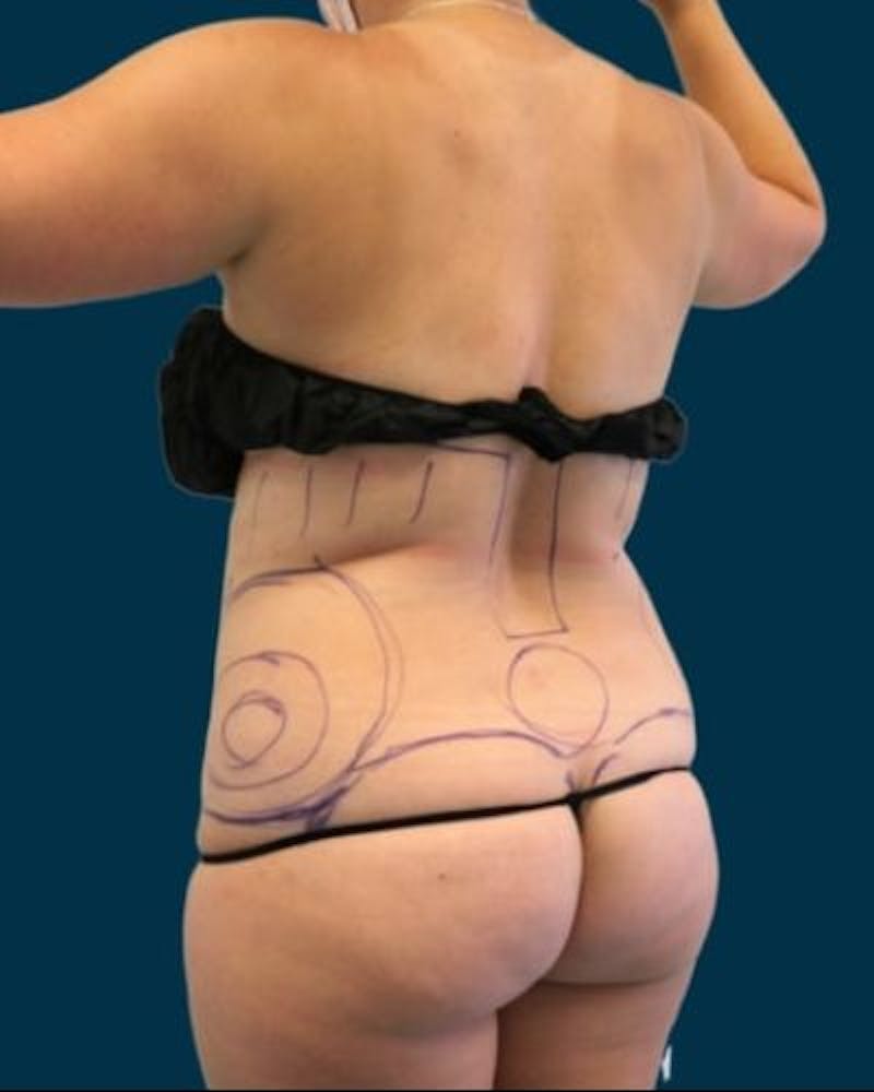 Tummy Tuck Before & After Gallery - Patient 310180 - Image 7