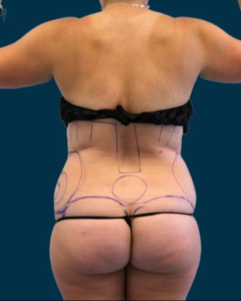 Tummy Tuck Before & After Gallery - Patient 310180 - Image 9