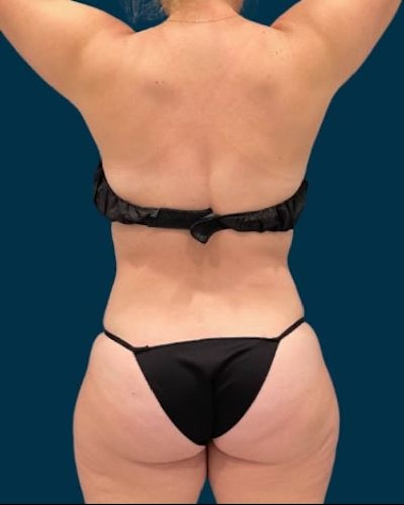 Tummy Tuck Before & After Gallery - Patient 310180 - Image 10