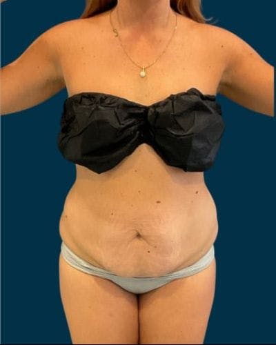Tummy Tuck Before & After Gallery - Patient 215996 - Image 1