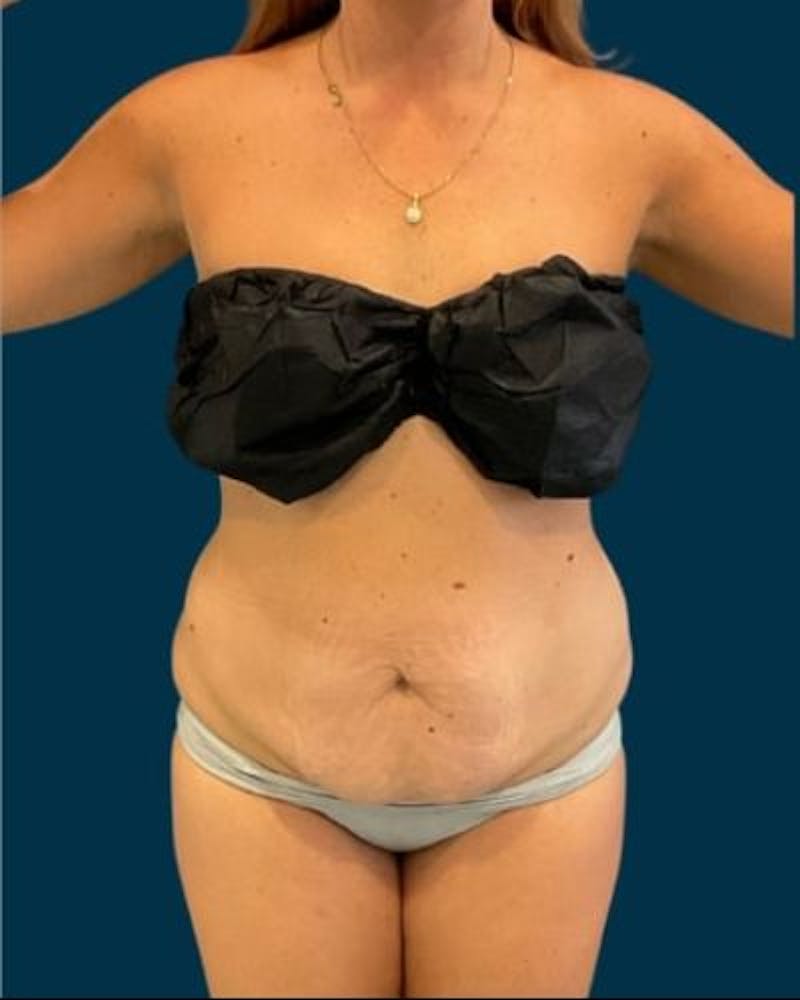 Tummy Tuck Before & After Gallery - Patient 215996 - Image 1
