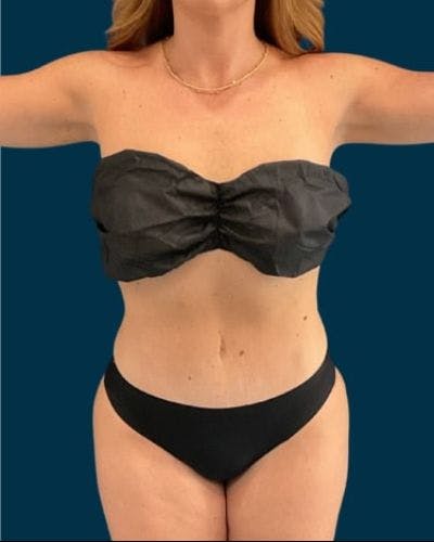 Tummy Tuck Before & After Gallery - Patient 215996 - Image 2