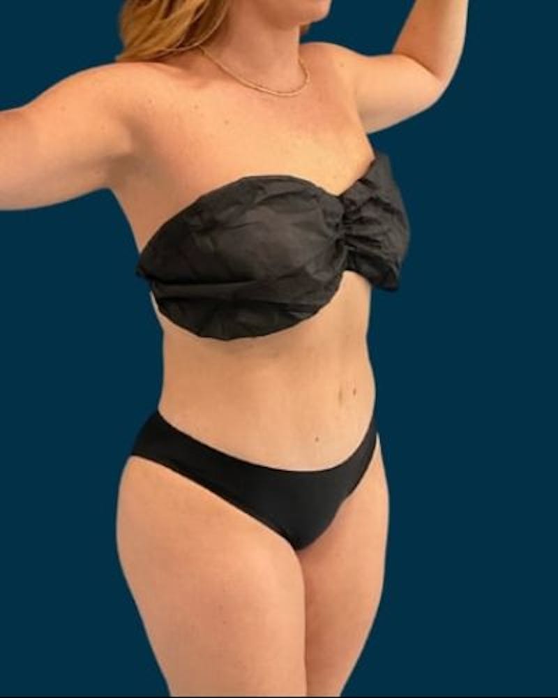 Tummy Tuck Before & After Gallery - Patient 215996 - Image 4