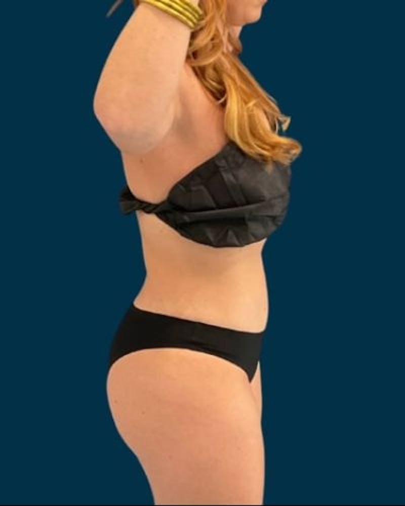 Tummy Tuck Before & After Gallery - Patient 215996 - Image 6
