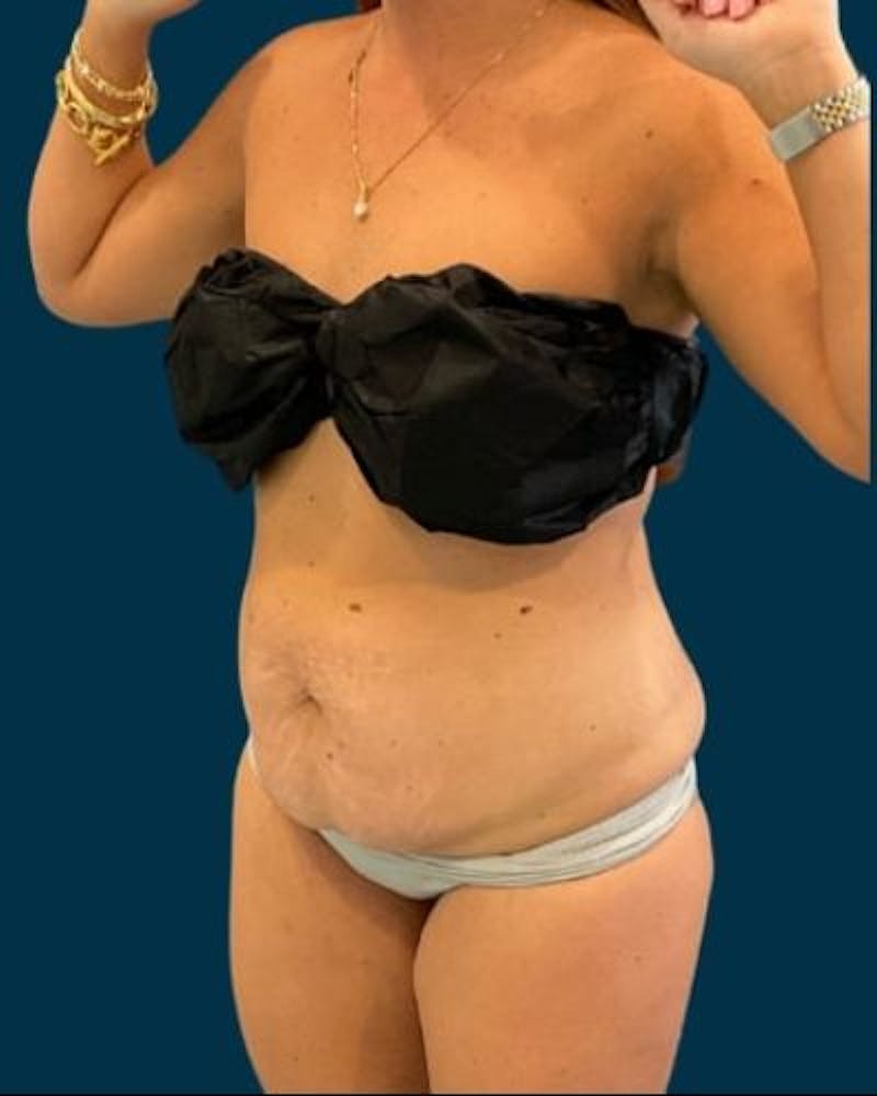 Tummy Tuck Before & After Gallery - Patient 215996 - Image 7