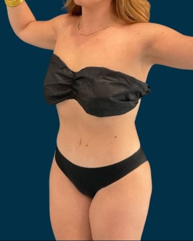 Tummy Tuck Before & After Gallery - Patient 215996 - Image 8