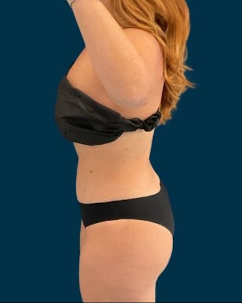 Tummy Tuck Before & After Gallery - Patient 215996 - Image 10