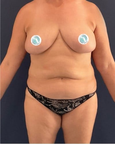 Tummy Tuck Before & After Gallery - Patient 382851 - Image 1