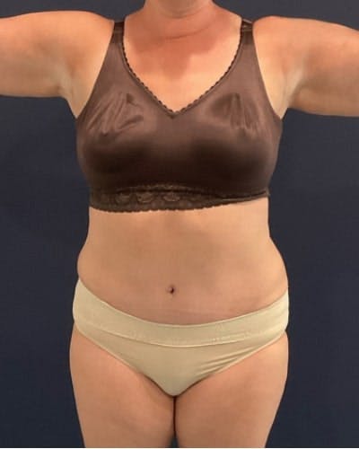 Tummy Tuck Before & After Gallery - Patient 382851 - Image 2