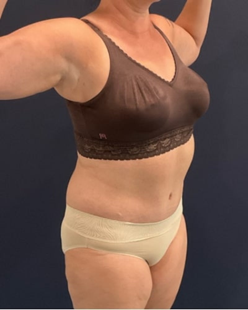 Tummy Tuck Before & After Gallery - Patient 382851 - Image 4