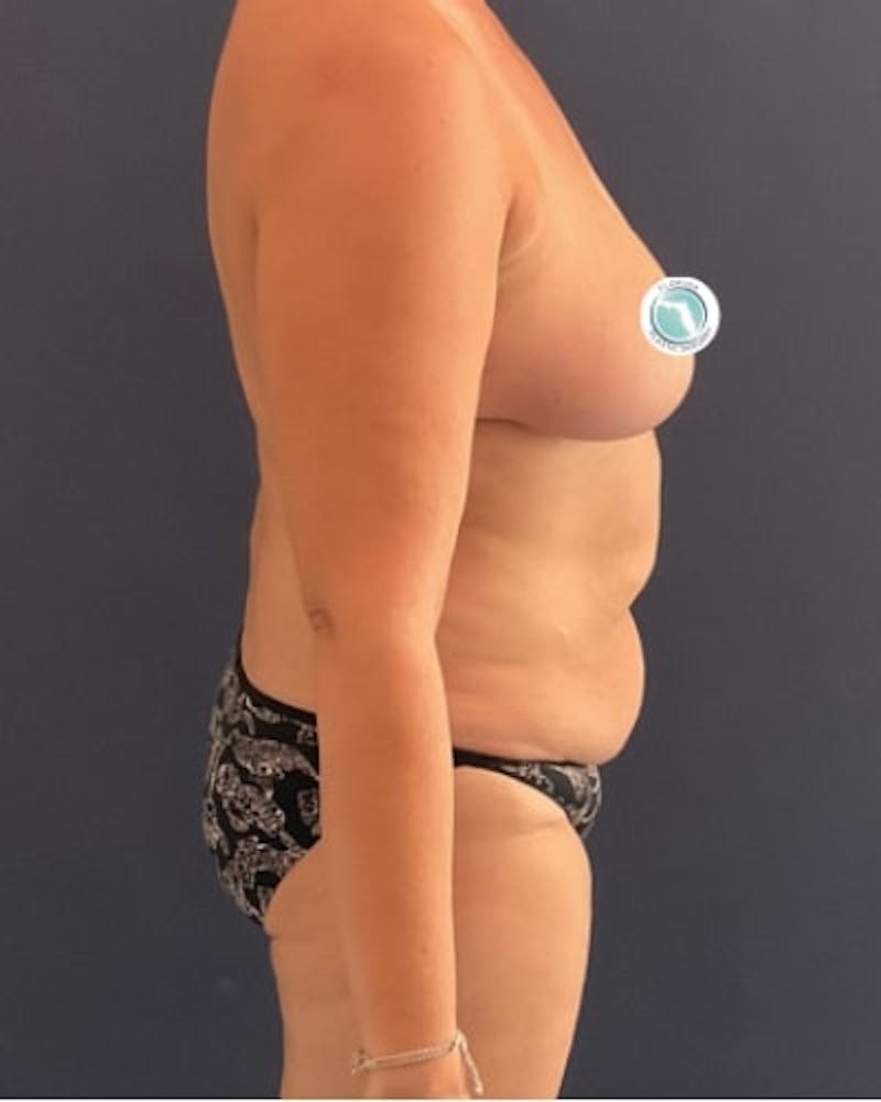 Tummy Tuck Before & After Gallery - Patient 382851 - Image 5