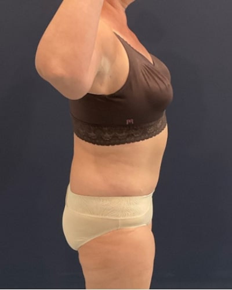 Tummy Tuck Before & After Gallery - Patient 382851 - Image 6