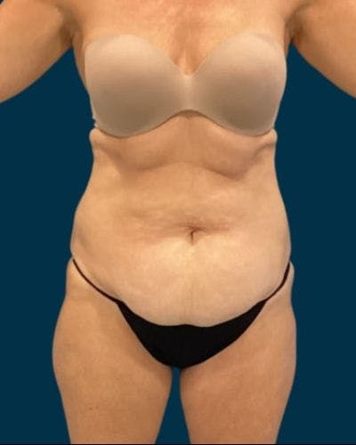 Tummy Tuck Before & After Gallery - Patient 419162 - Image 1