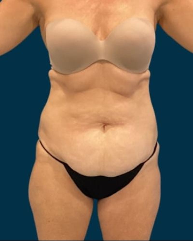 Tummy Tuck Before & After Gallery - Patient 419162 - Image 1
