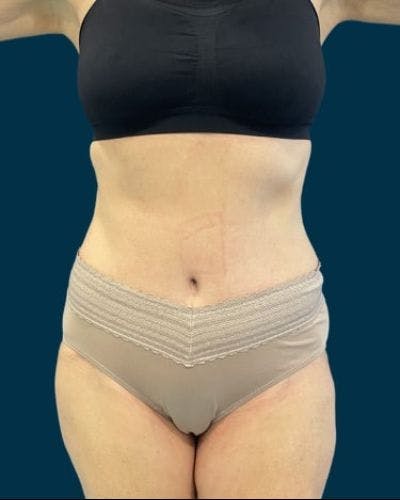 Tummy Tuck Before & After Gallery - Patient 419162 - Image 2