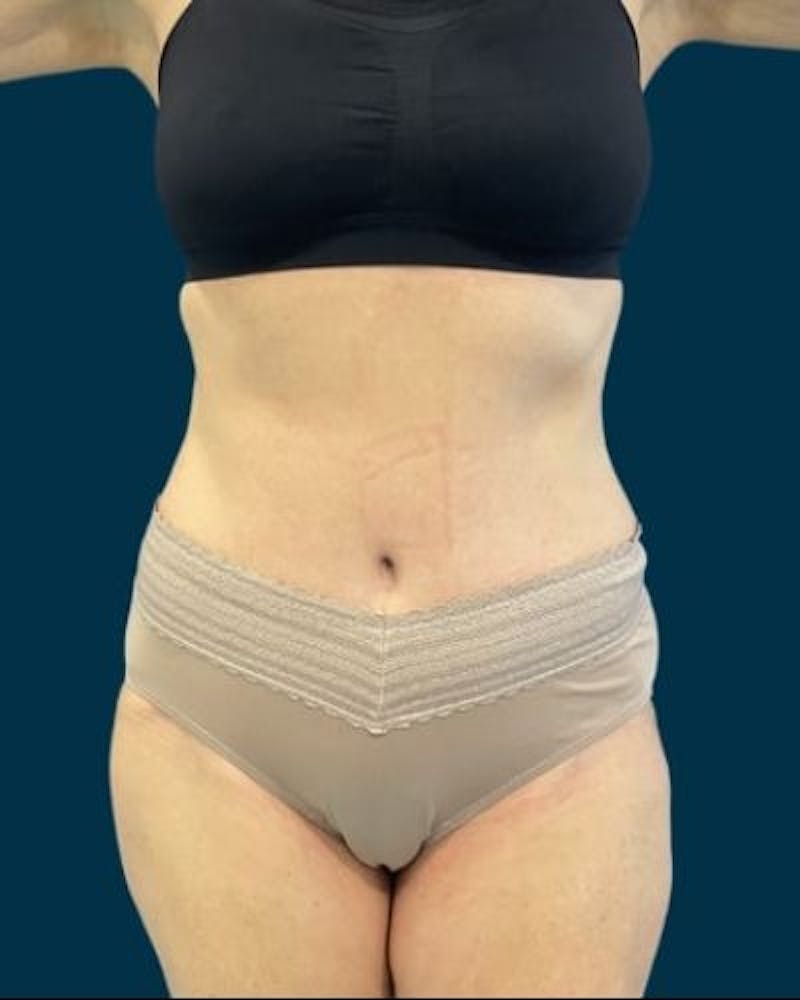 Tummy Tuck Before & After Gallery - Patient 419162 - Image 2