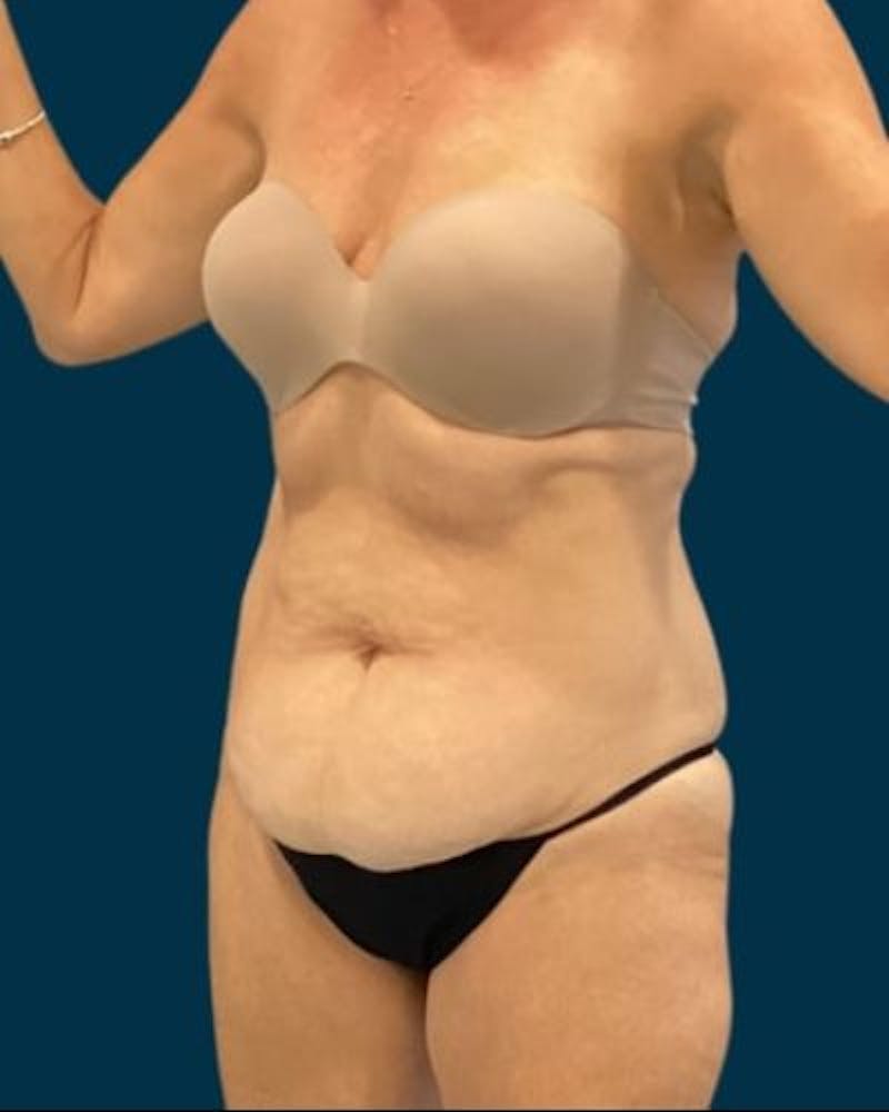 Tummy Tuck Before & After Gallery - Patient 419162 - Image 3
