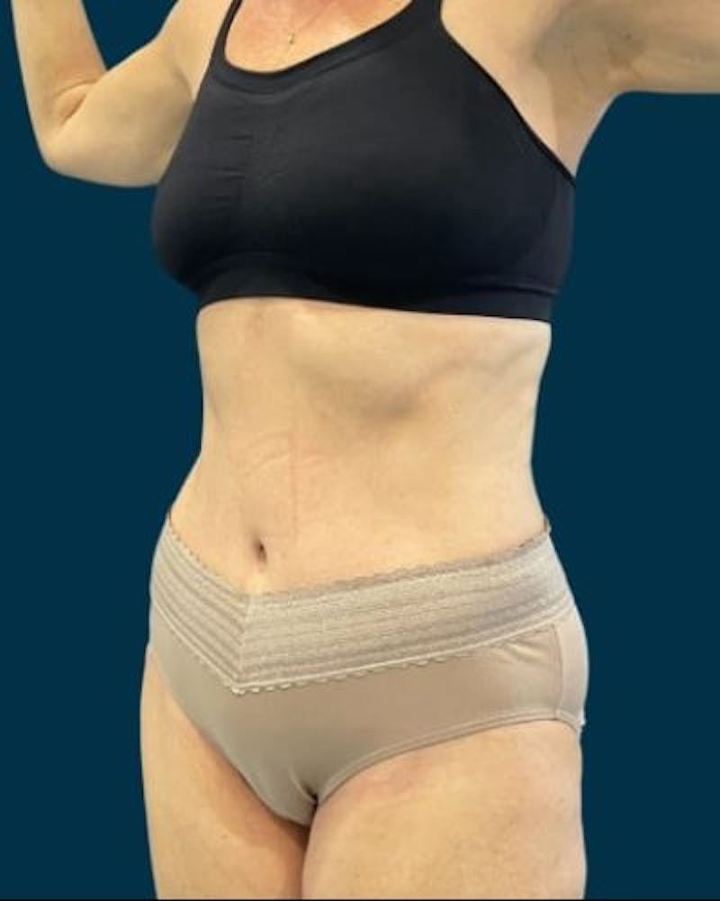 Tummy Tuck Before & After Gallery - Patient 419162 - Image 4
