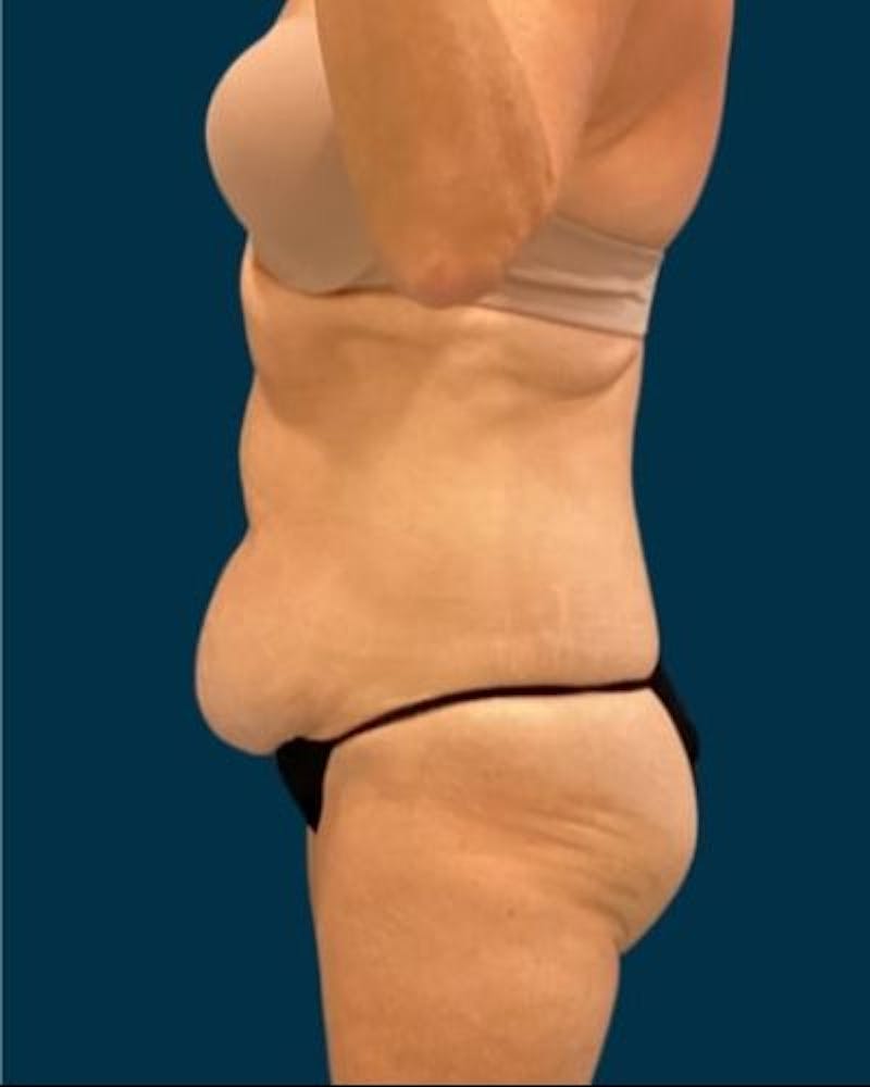 Tummy Tuck Before & After Gallery - Patient 419162 - Image 5