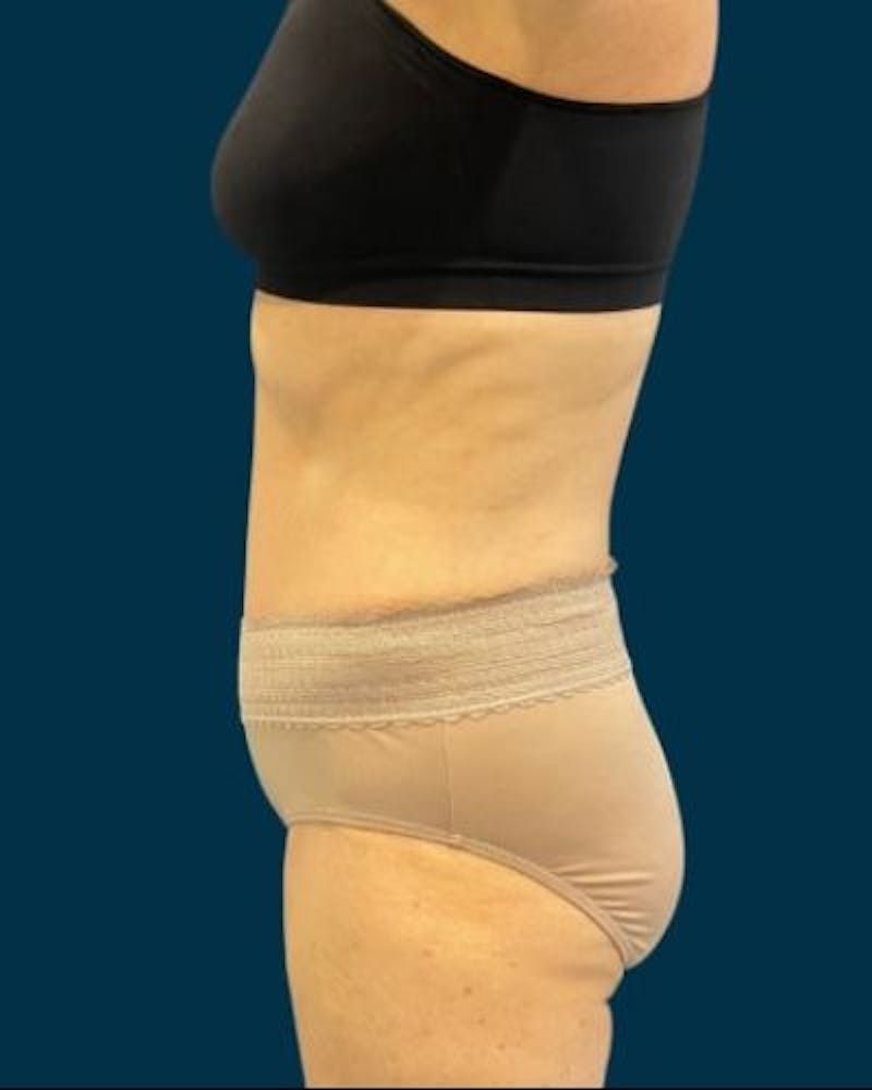 Tummy Tuck Before & After Gallery - Patient 419162 - Image 6