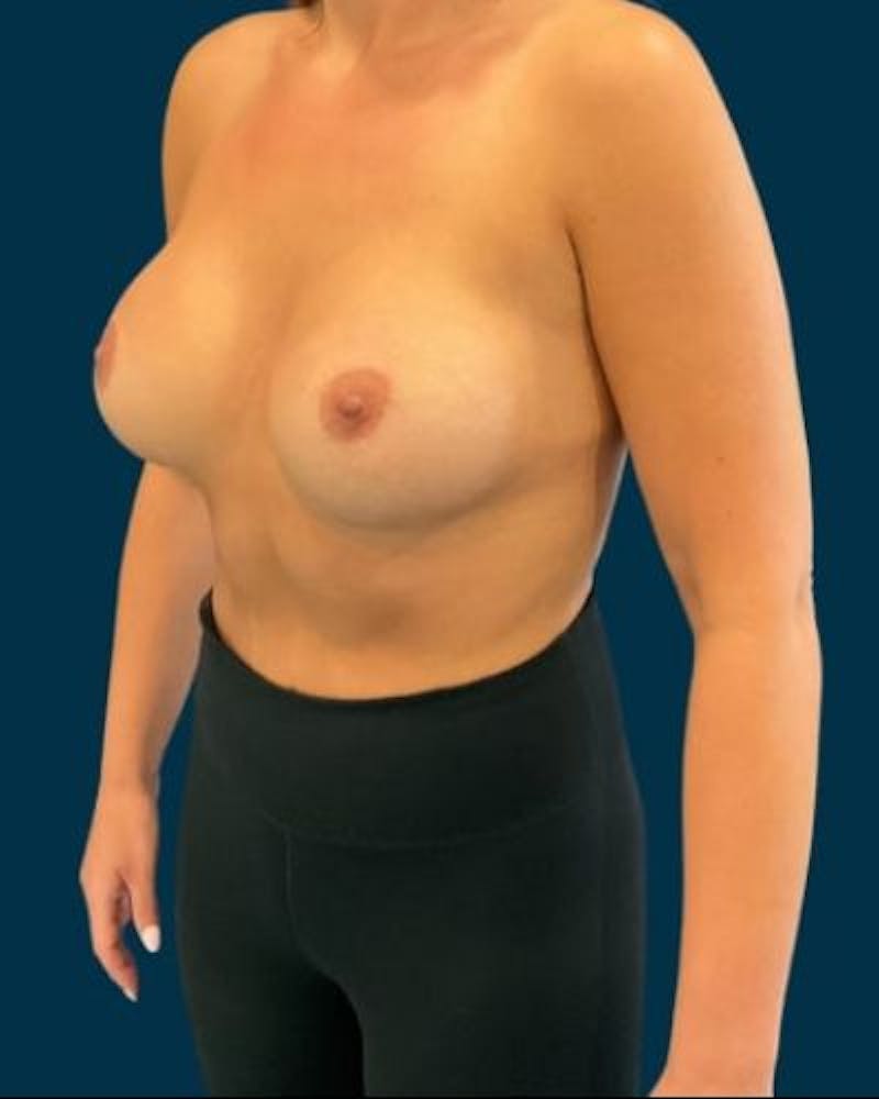 Tummy Tuck Before & After Gallery - Patient 167019 - Image 6