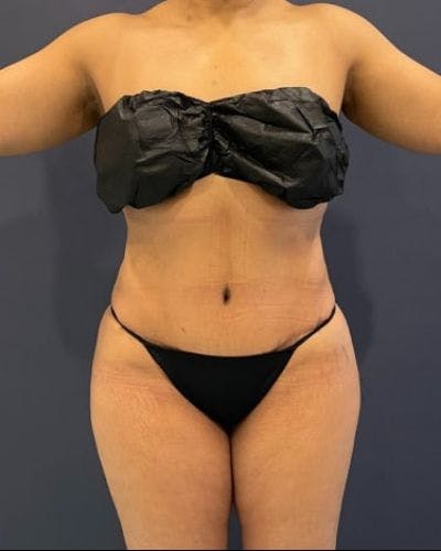 Tummy Tuck Before & After Gallery - Patient 307026 - Image 2